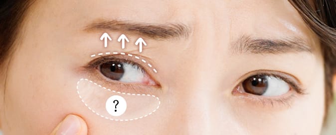 まぶたリフト（切らないまぶたのたるみ取り）【画像】
