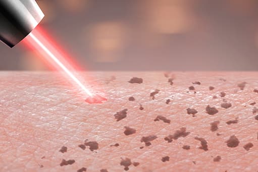 レーザートーニング