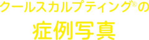 クールスカルプティング&reg;のビフォーアフター