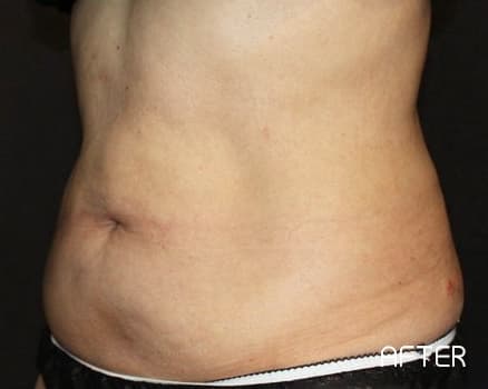 クールスカルプティング&reg;の症例写真 After