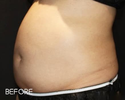 クールスカルプティング&reg;の症例写真 Before