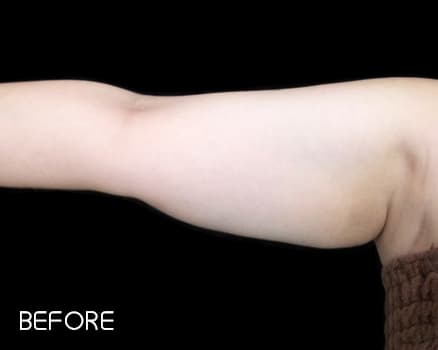 クールスカルプティング&reg;の症例写真 Before