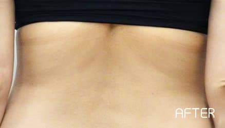 クールスカルプティング&reg;の症例写真 After