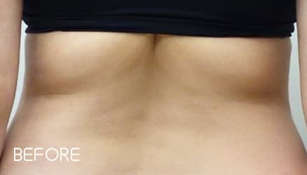 クールスカルプティング&reg;の症例写真 Before