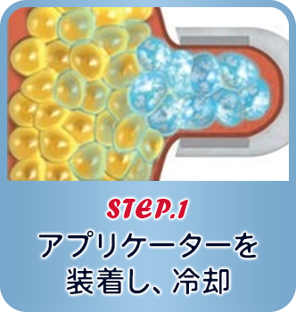 STEP.1 アプリケーター装着、冷却開始