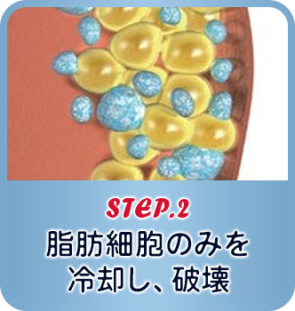 STEP.2 凍った脂肪細胞のみが破壊
