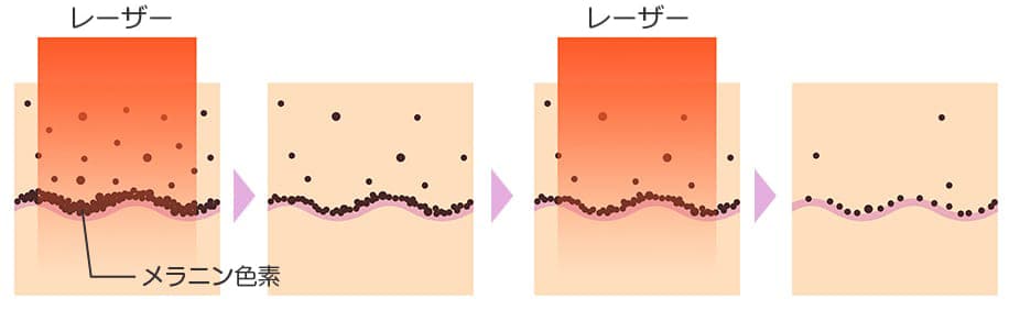 レーザー光、メラニン色素【画像】