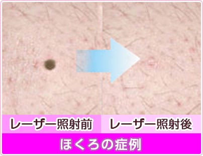 ほくろの症例 レーザー照射前 レーザー照射後【画像】