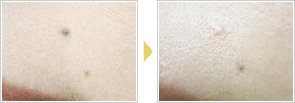 施術3か月後の様子です。