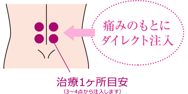 痛みのもとにダイレクト注入