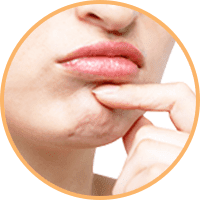 アゴの梅干しジワ【画像】