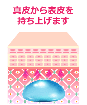 注入後の肌 真皮から表皮を持ち上げます