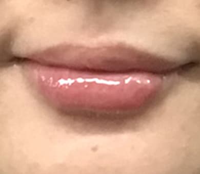 唇(レッド・グロス注射)