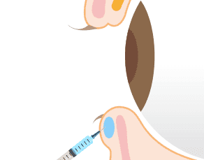 涙袋ヒアルロン酸注入とは【画像】