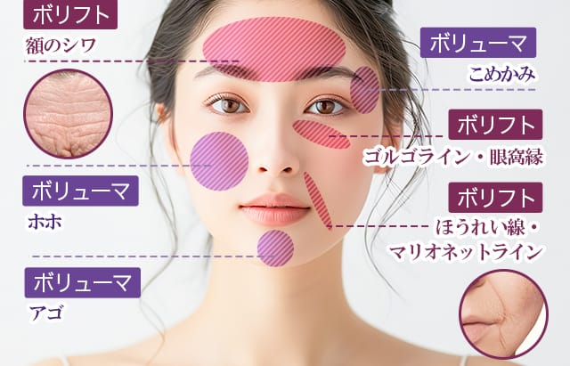 ボリフト：額のシワ・ゴルゴライン・眼窩縁 ボリューマ：こめかみ・ホホ・アゴ