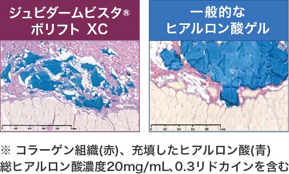 【ジュビダームビスタ&reg;ボリフトXC】【一般的なヒアルロン酸ゲル】※コラーゲン組織（赤）、充填したヒアルロン酸（青）総ヒアルロン酸濃度20mg/ｍL、0.3リドカインを含む