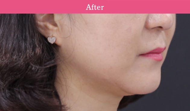 3D HIFUの症例写真1 after【画像】