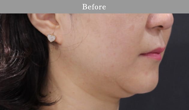 3D HIFUの症例写真1 before【画像】