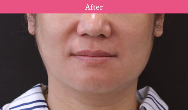 3D HIFUの症例写真2 after【画像】