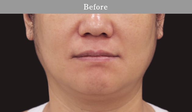 3D HIFUの症例写真2 before【画像】