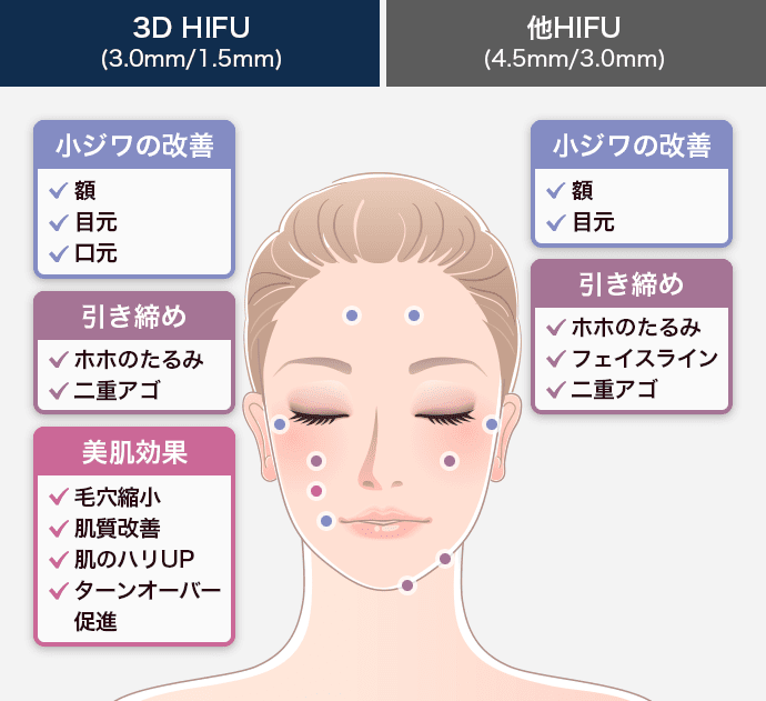 3D HIFUの適応部位、他HIFUとの違い