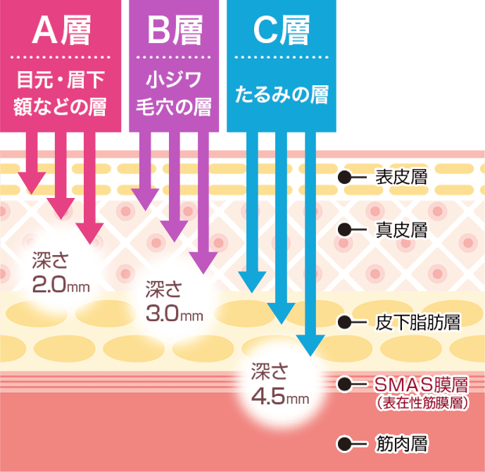A層目元・眉下額などの層深さ2.0mm。B層小ジワ・毛穴の層深さ3.0mm。C層たるみの層深さ4.5mm。【画像】