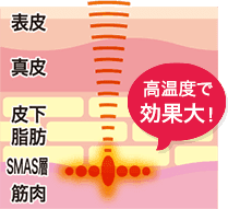 点状方式（広範囲に広がる）
