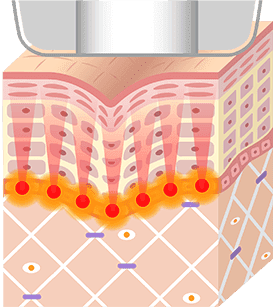 超音波エネルギーを照射