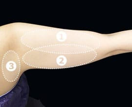 クールスカルプティング&reg;：脂肪を冷却して破壊する痩身術。治療部位1【画像】