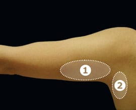 クールスカルプティング&reg;：脂肪を冷却して破壊する痩身術。治療部位3【画像】