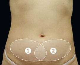 クールスカルプティング&reg;：脂肪を冷却して破壊する痩身術。治療部位4【画像】