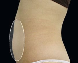 クールスカルプティング&reg;：脂肪を冷却して破壊する痩身術。治療部位6【画像】