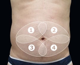 クールスカルプティング&reg;：脂肪を冷却して破壊する痩身術。治療部位9【画像】