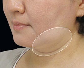 クールスカルプティング&reg;：脂肪を冷却して破壊する痩身術。治療部位12【画像】