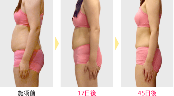 モニター 施術前/17日後/45日後