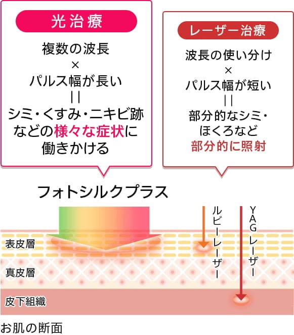 【フォトシルクプラス：ルビーレーザー、YAGレーザー】光治療：複数の波長×パルス幅が長い＝シミ・くすみ・ニキビ跡などの様々な症状に働きかける【ルビーレーザー・YAGレーザー】レーザー治療：波長の使い分け×パルス幅が短い＝部分的なシミ・ほくろなど部分的に照射