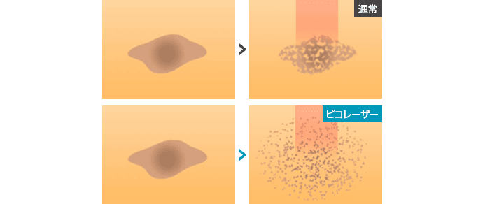 従来のレーザーに比べ、ピコレーザーはメラニン色素の粒子をより細かく破壊【画像】