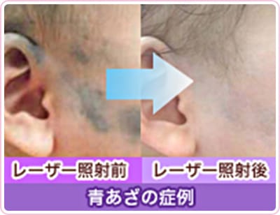 青あざの症例。レーザー照射前、レーザー照射後。【画像】