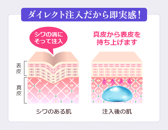 ダイレクト注入だから即実感！シワのある肌、表皮・真皮、シワの溝にそって注入。注入後の肌、真皮から表皮を持ち上げます。