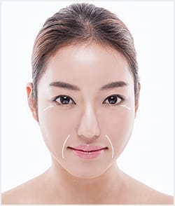 真顔の状態でできているシワはヒアルロン酸注入で改善【画像】