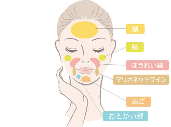 ジュビダームビスタ&reg; ウルトラの対象部位：額・ホホ・ほうれい線・マリオネットライン・アゴ・おとがい部【画像】