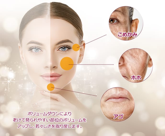 ボリュームダウンにより老けて見られやすい部位のボリュームをアップし、若々しさを取り戻します。 こめかみ、ホホ、アゴ【画像】