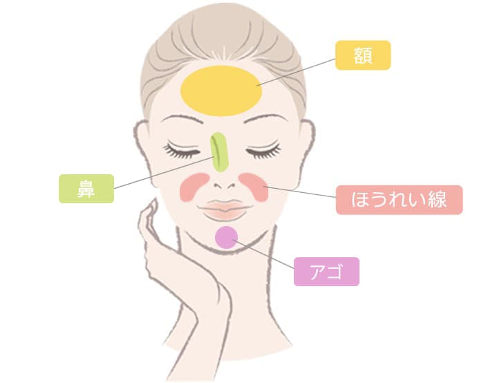 ヒアルロン酸 レスチレン&reg;リドの処置部位：額・ほうれい線・鼻・アゴ【画像】