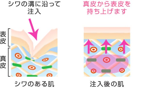 シワの溝に沿って注入 真皮から表皮を持ち上げます
