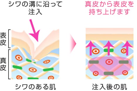 シワの溝にそってヒアルロン酸注入 真皮から表皮を持ち上げます