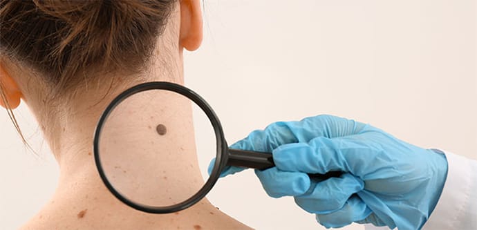 ほくろ・いぼの種類について【画像】