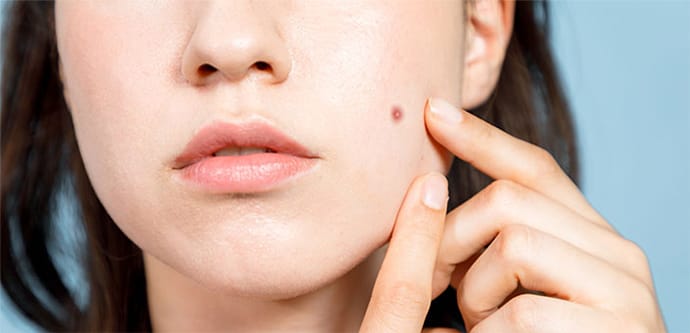 ほくろ・いぼは除去すべきなの？【画像】