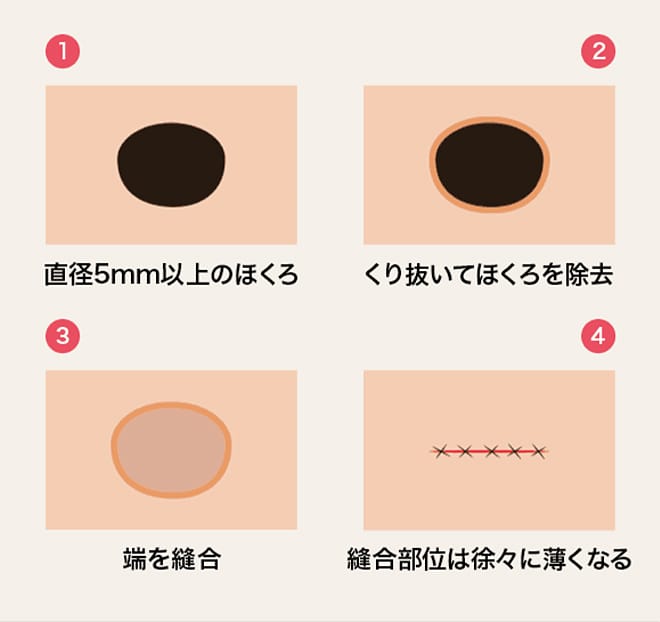 ①直径5mm以上のほくろ ②くり抜いてほくろを除去 ③端を縫合④ 縫合部位は徐々に薄くなる