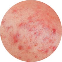 ニキビとは【画像】