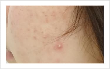 初期ニキビ（白ニキビ）【画像】